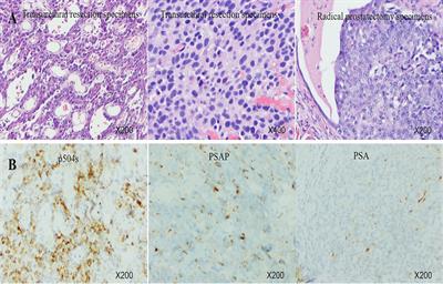 Platinum-Based Neoadjuvant Chemotherapy Before Radical Prostatectomy for Locally Advanced Prostate Cancer With Homologous Recombination Deficiency: A Case Report